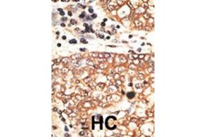 Formalin-fixed and paraffin-embedded human cancer tissue reacted with the primary antibody, which was peroxidase-conjugated to the secondary antibody, followed by AEC staining. (Neuregulin 2 抗体  (C-Term))