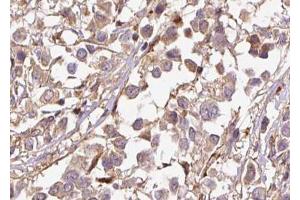 ABIN6267501 at 1/100 staining human breast carcinoma tissue sections by IHC-P. (p21 抗体  (pThr145))