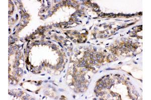 Anti- Parvin alpha Picoband antibody, IHC(P) IHC(P): Human Mammary Cancer Tissue (Parvin alpha 抗体  (Middle Region))