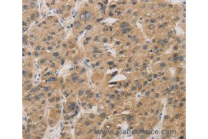 Immunohistochemistry of Human gastric cancer using DDIT4 Polyclonal Antibody at dilution of 1:30 (DDIT4 抗体)