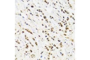 Immunohistochemistry of paraffin-embedded human breast cancer using RAD50 Antibody. (RAD50 抗体)