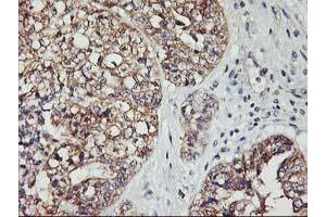 Immunohistochemical staining of paraffin-embedded Adenocarcinoma of Human ovary tissue using anti-PDSS2 mouse monoclonal antibody. (PDSS2 抗体)