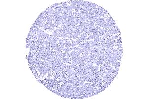 Hepatocellular carcinoma without AGR2 staining of tumor cells (Recombinant AGR2 抗体)