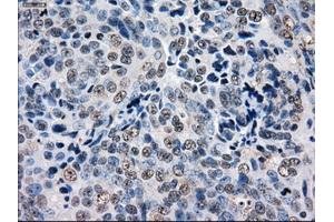 Immunohistochemical staining of paraffin-embedded Adenocarcinoma of ovary tissue using anti-GBE1 mouse monoclonal antibody. (GBE1 抗体)