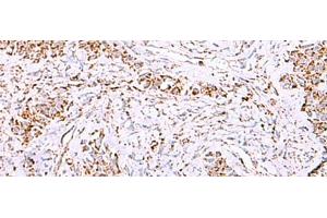Immunohistochemistry of paraffin-embedded Human ovarian cancer tissue using HSF2BP Polyclonal Antibody at dilution of 1:30(x200) (HSF2BP 抗体)