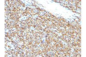 Formalin-fixed, paraffin-embedded human Ewing's Sarcoma stained with CD99 Monoclonal Antibody (12E7). (CD99 抗体)