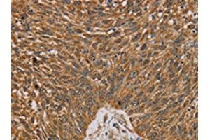 The image on the left is immunohistochemistry of paraffin-embedded Human lung cancer tissue using ABIN7130359(NDEL1 Antibody) at dilution 1/20, on the right is treated with fusion protein. (NDEL1 抗体)
