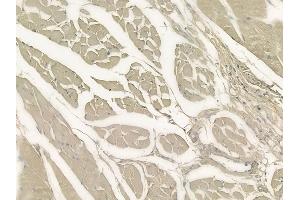 ABIN6264770 and ABIN6273310 at 1/100 staining human tongue carcinoma by IHC-P. (RLBP1 抗体  (Internal Region))