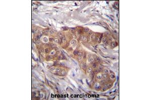 LR6 Antibdy (Center) (ABIN656635 and ABIN2845880) immunohistochemistry analysis in formalin fixed and raffin embedded human breast carcinoma followed by peroxidase conjugation of the secondary antibody and DAB staining. (LPAR6 抗体  (AA 106-134))