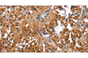 Immunohistochemistry of paraffin-embedded Human thyroid cancer tissue using CAMK1D Polyclonal Antibody at dilution 1:50 (CAMK1D 抗体)