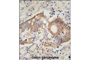 HHLA2 Antibody immunohistochemistry analysis in formalin fixed and paraffin embedded human colon carcinoma followed by peroxidase conjugation of the secondary antibody and DAB staining. (HHLA2 抗体  (N-Term))