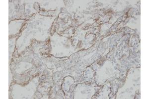 IHC-P Image Immunohistochemical analysis of paraffin-embedded human T(IV)(lung CA), using CLIC3, antibody at 1:100 dilution. (CLIC3 抗体)