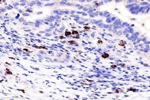 Immunohistochemistry analysis of paraffin-embedded human lung cancer using TCRb (ABIN7075813) at dilution of 1: 1800 (TCRb 抗体)