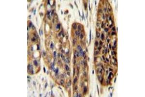 Immunohistochemistry analysis in formalin fixed and paraffin embedded human esophagus carcinoma reacted with KIAA1324L Antibody (N-term) followed which was peroxidase conjugated to the secondary antibody and ollowed by DAB staining. (KIAA1324-Like 抗体  (N-Term))