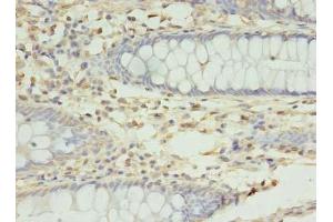 Immunohistochemistry of paraffin-embedded human colon cancer using ABIN7166018 at dilution of 1:100 (RMND5B 抗体  (AA 1-260))