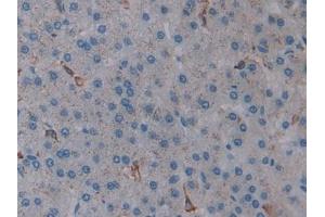 Detection of HO1 in Human Liver cancer Tissue using Polyclonal Antibody to Heme Oxygenase 1 (HO1)