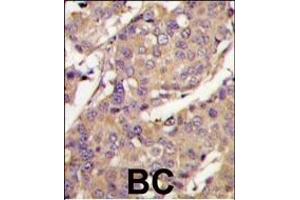 Formalin-fixed and paraffin-embedded breast carcinoma tissue reacted with UBE2L6 Antibody (C-term) (ABIN388854 and ABIN2839156) , which was peroxidase-conjugated to the secondary antibody, followed by DAB staining. (UBE2L6 抗体  (C-Term))