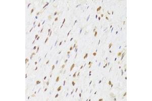 Immunohistochemistry of paraffin-embedded human gastric cancer using RUVBL1 Antibody. (RUVBL1 抗体  (AA 1-240))