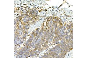 Immunohistochemistry of paraffin-embedded human esophageal cancer using IFIH1 Rabbit pAb (ABIN6131879, ABIN6142174, ABIN6142175 and ABIN6217724) at dilution of 1:50 (40x lens). (IFIH1 抗体  (AA 1-205))