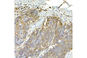 Immunohistochemistry of paraffin-embedded human esophageal cancer using IFIH1 Rabbit pAb (ABIN6131879, ABIN6142174, ABIN6142175 and ABIN6217724) at dilution of 1:50 (40x lens). (IFIH1 抗体  (AA 1-205))