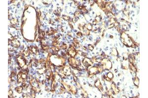 Formalin-fixed, paraffin-embedded human Angiosarcoma stained with Podocalyxin Monoclonal Antibody (2A4).