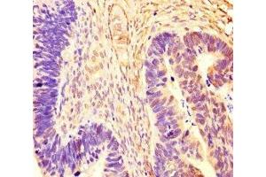 Immunohistochemistry of paraffin-embedded human ovarian cancer using ABIN7167721 at dilution of 1:100 (CoREST 抗体  (AA 394-482))
