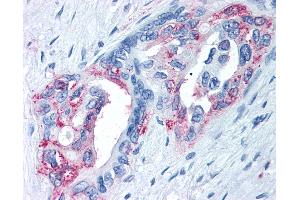 Anti-TRPM8 antibody IHC of human Pancreas, Carcinoma. (TRPM8 抗体  (Internal Region))
