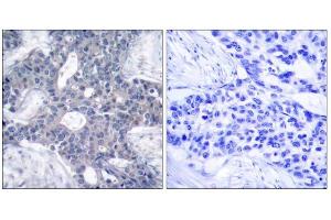Immunohistochemical analysis of paraffin-embedded human breast carcinoma tissue, using Zap-70 (Ab-493) antibody (E021174). (ZAP70 抗体)