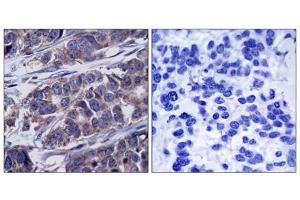 Immunohistochemical analysis of paraffin-embedded human breast carcinoma tissue, using p62Dok (phospho-Tyr362) antibody (E011276). (DOK1 抗体  (pTyr362))