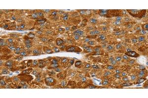 Immunohistochemistry of paraffin-embedded Human liver cancer tissue using SPARCL1 Polyclonal Antibody at dilution 1:30 (SPARCL1 抗体)