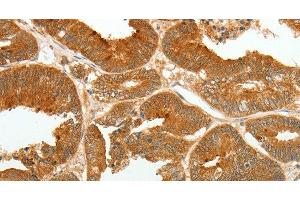 Immunohistochemistry of paraffin-embedded Human colon cancer tissue using ASCL1 Polyclonal Antibody at dilution 1:30 (ASCL1 抗体)