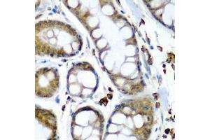 Immunohistochemistry of paraffin-embedded human colon carcinoma using SECISBP2 antibody (ABIN6128699, ABIN6147497, ABIN6147498 and ABIN6222461) at dilution of 1:200 (40x lens). (SECISBP2 抗体  (AA 585-854))