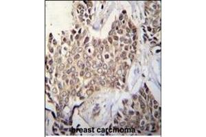 ZBTB42 Antibody (N-term) (ABIN655541 and ABIN2845052) immunohistochemistry analysis in formalin fixed and paraffin embedded human breast tissue followed by peroxidase conjugation of the secondary antibody and DAB staining. (ZBTB42 抗体  (N-Term))