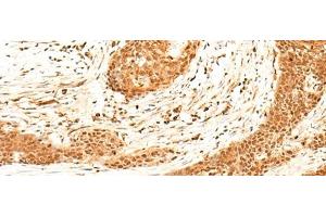 Immunohistochemistry of paraffin-embedded Human esophagus cancer tissue using HNF4A Polyclonal Antibody at dilution of 1:40(x200) (HNF4A 抗体)