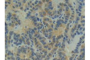 IHC-P analysis of Human Thyroid cancer Tissue, with DAB staining. (Apolipoprotein M 抗体  (AA 8-188))