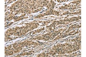 The image on the left is immunohistochemistry of paraffin-embedded Human gastic cancer tissue using ABIN7129356(ELAC2 Antibody) at dilution 1/30, on the right is treated with fusion protein. (ELAC2 抗体)