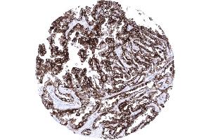 Strong membranous CD7 expression of an adenocarcinoma of the lung (Recombinant CD7 抗体)