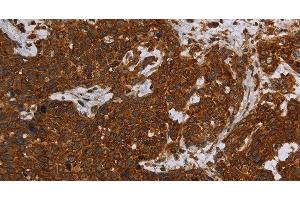 Immunohistochemistry of paraffin-embedded Human cervical cancer tissue using ERRFI1 Polyclonal Antibody at dilution 1:30 (ERRFI1 抗体)