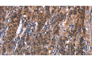 Immunohistochemistry of paraffin-embedded Human gastric cancer tissue using R3HCC1L Polyclonal Antibody at dilution 1:40 (GIDRP88 抗体)