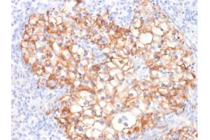 Formalin-fixed, paraffin-embedded human Renal Cell Carcinoma stained with CDH16-Monospecific Mouse Monoclonal Antibody (CDH16/2125). (Cadherin-16 抗体  (AA 371-507))