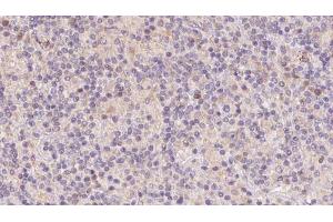 ABIN6273112 at 1/100 staining Human lymph cancer tissue by IHC-P. (DnaJ (Hsp40) Homolog, Subfamily B, Member 3 (DNAJB3) (Internal Region) 抗体)