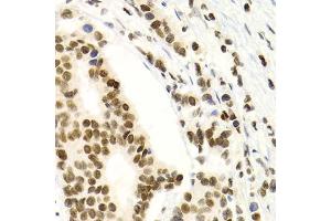 Immunohistochemistry of paraffin-embedded human breast cancer using NFKB2 Antibody (ABIN1873900) at dilution of 1:100 (40x lens). (NFKB2 抗体)