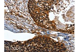 The image on the left is immunohistochemistry of paraffin-embedded Human esophagus cancer tissue using ABIN7131518(TWF1 Antibody) at dilution 1/30, on the right is treated with fusion protein. (TWF1 抗体)