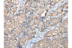 The image on the left is immunohistochemistry of paraffin-embedded Human breast cancer tissue using ABIN7128073(VAPA Antibody) at dilution 1/30, on the right is treated with fusion protein. (VAPA 抗体)