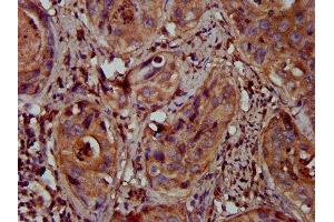 IHC image of ABIN7159706 diluted at 1:300 and staining in paraffin-embedded human cervical cancer performed on a Leica BondTM system. (MFAP4 抗体  (AA 100-191))
