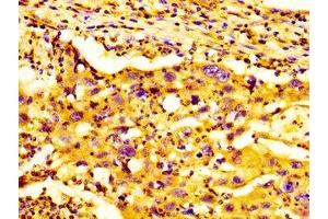 IHC image of ABIN7154550 diluted at 1:300 and staining in paraffin-embedded human lung cancer performed on a Leica BondTM system. (GDF7 抗体  (AA 322-450))
