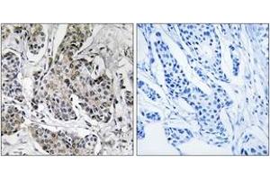 Immunohistochemistry analysis of paraffin-embedded human breast carcinoma tissue, using PRKX Antibody. (PRKX 抗体  (AA 251-300))