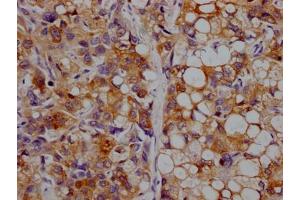IHC image of ABIN7127343 diluted at 1:100 and staining in paraffin-embedded human liver cancer performed on a Leica BondTM system. (Recombinant APOC3 抗体)