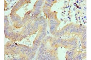 Immunohistochemistry of paraffin-embedded human colon cancer using ABIN7143994 at dilution of 1:100 (AIMP1 抗体  (AA 25-180))