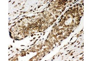 IHC-P: Lamin A antibody testing of human breast cancer tissue (Lamin A/C 抗体  (AA 481-646))